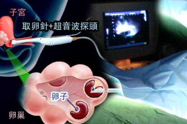 武汉助孕一般多钱 2023年武汉同济医院第三代试管多少费用? ‘四维彩超红色区